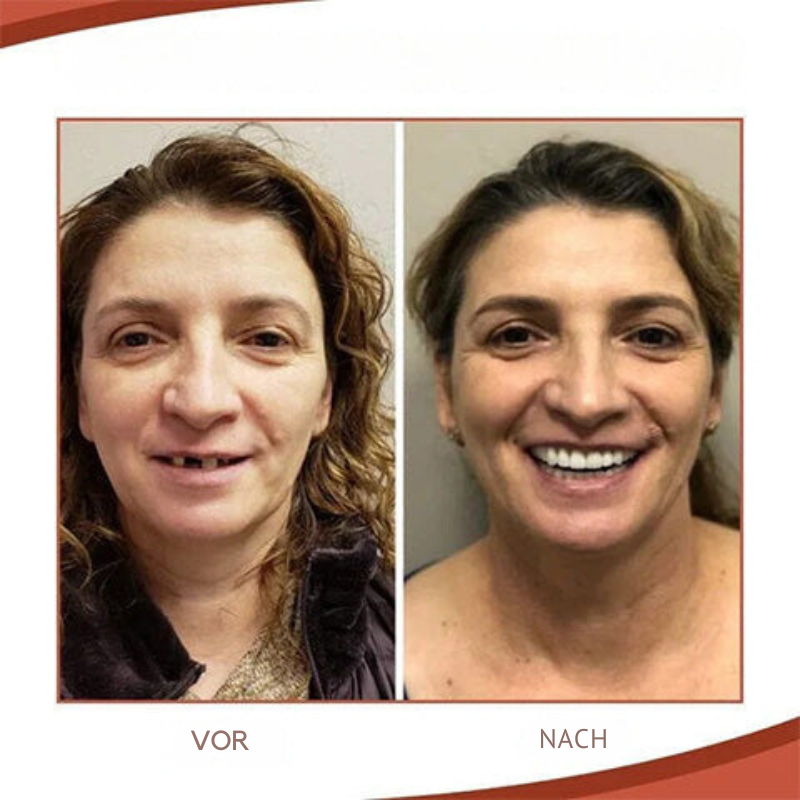 Silicone snap-on cosmetic teeth veneers