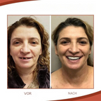 Silicone snap-on cosmetic teeth veneers